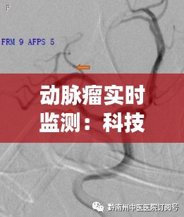 动脉瘤实时监测：科技守护生命线