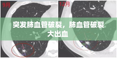 突发肺血管破裂，肺血管破裂大出血 