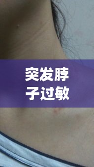 突发脖子过敏，脖子突然过敏是怎么回事 